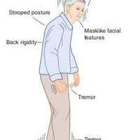 Parkinson